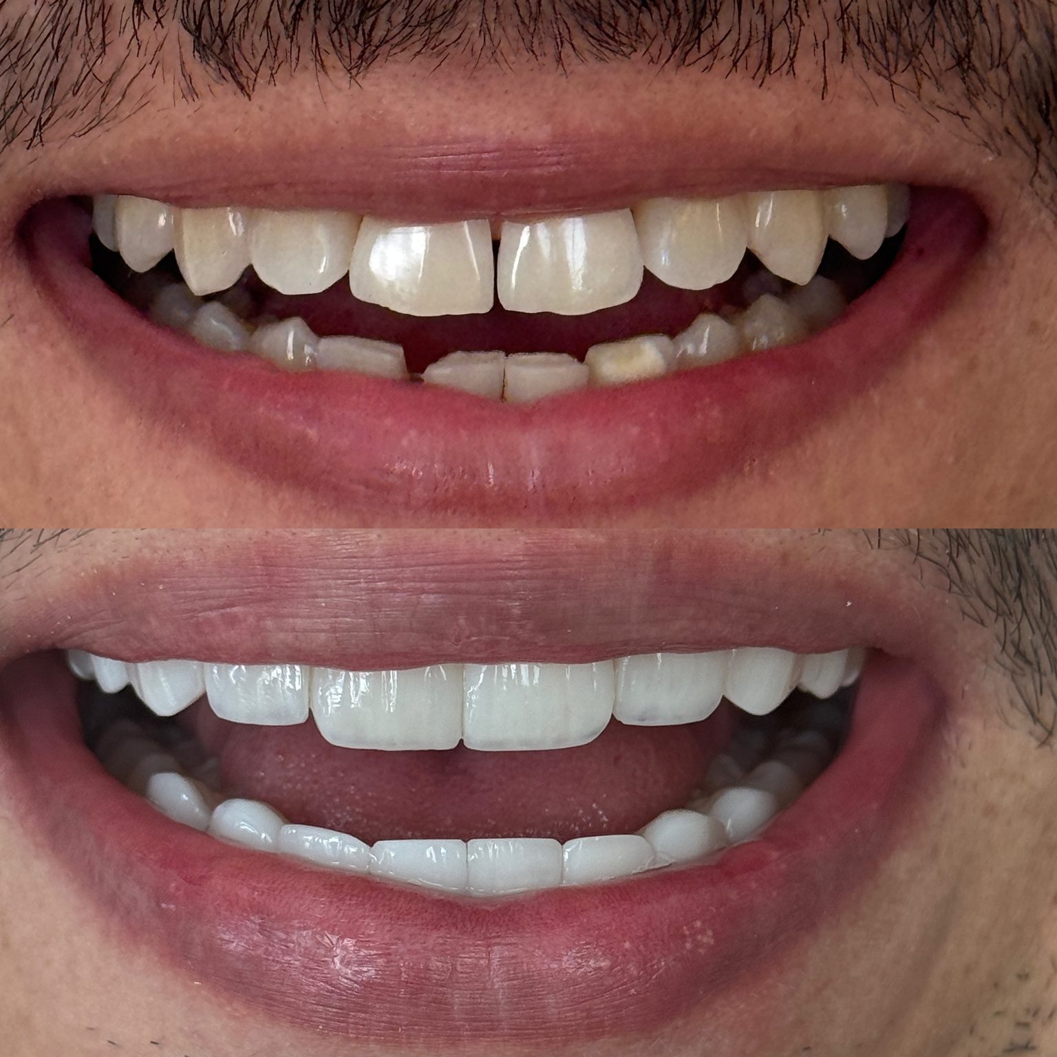 Antes e depois de tratamento estético do sorriso, caso 1
