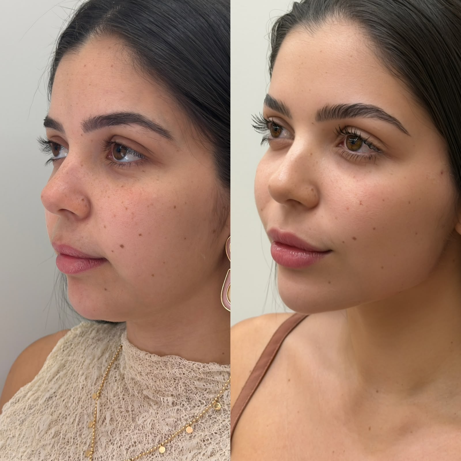 Antes e depois de harmonização orofacial