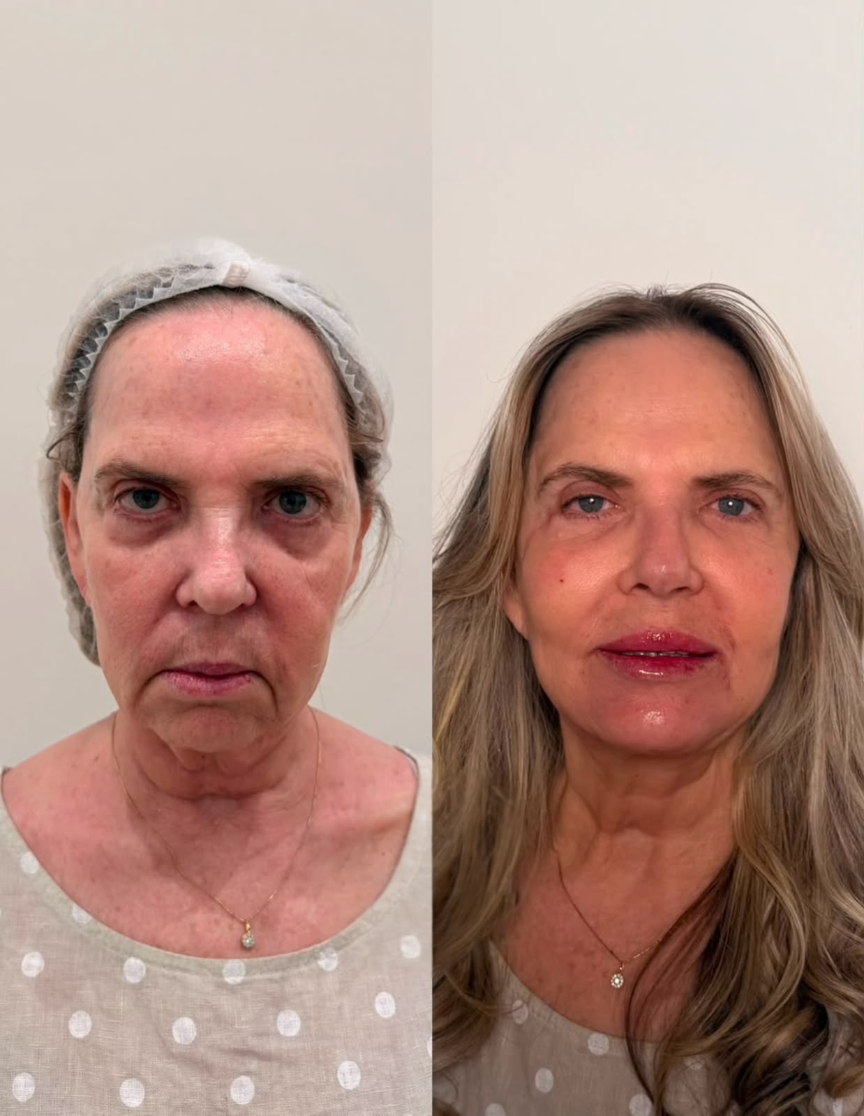 Antes e depois de harmonização orofacial